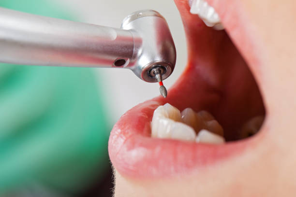 Best Emergency Dentist for Lost Fillings or Crowns in Merian, ID